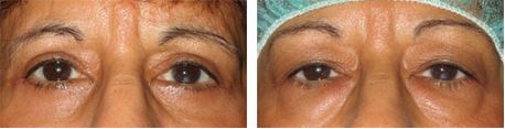 לפני ואחרי ניתוח לטיפול בשקיות מתחת לעיניים בעפעף התחתון