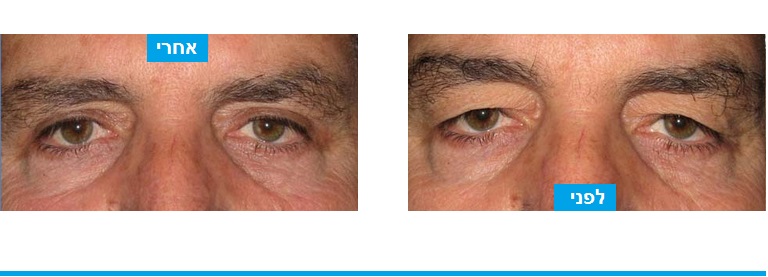 גבר שסבל מתחושת כובד ועייפות ועבר ניתוח עפעפיים במהלכו בוצעה הסרה של עודפי העור שלחצו על העין