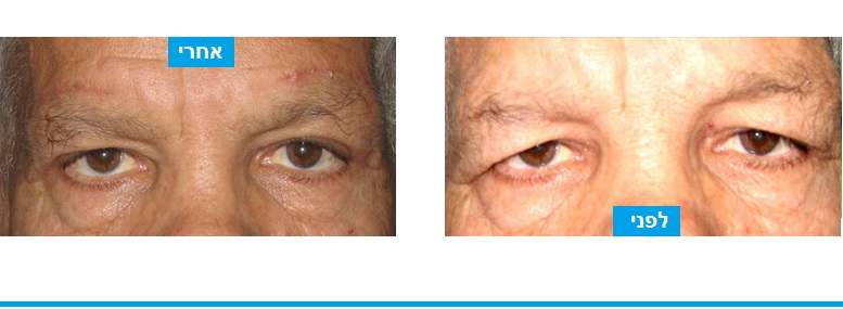 ניתוח עפעפיים לתיקון בעיה של עודפי עור בעפעף העליון המסתירים את העין